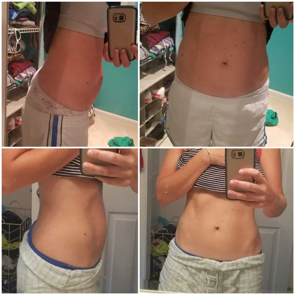Non-Surgical Cure for Umbilical Hernia and Diastasis
